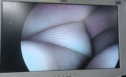 腹腔鏡的組成及STORZ腹腔鏡26003BA維修案例