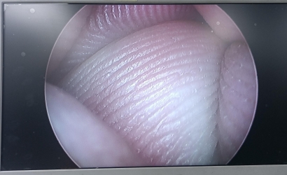 電切鏡的介紹及Wolf狼牌電切鏡8650.414維修案例分析