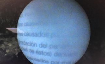 輸尿管鏡手術(shù)操作技巧的體會(huì)及R.Wolf輸尿管鏡的維修案例